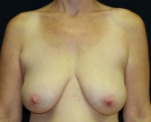Feel Beautiful - Breast Lift Case 10 - Before Photo